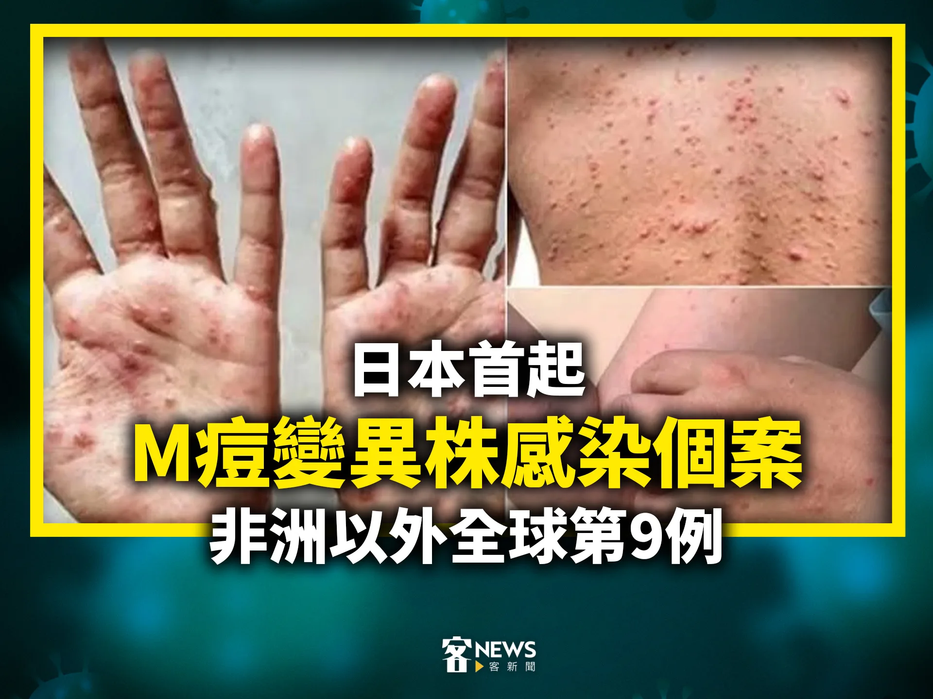 日本首起M痘變異株感染個案　非洲以外全球第9例's story cover image
