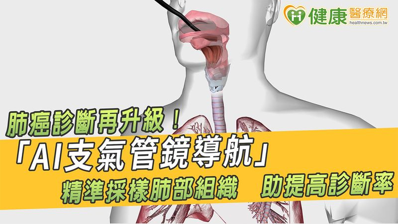 肺癌診斷再升級！「AI支氣管鏡導航」精準採樣肺部組織　助提高診斷率's story cover image