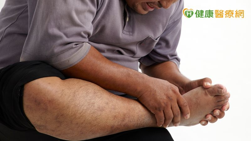 「腳腫如球」痛風如何治？基因檢測助攻 精準用藥更安心's story cover image