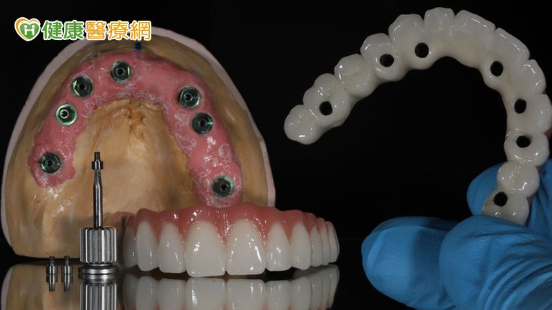 全口重建進入「精準導航」時代！「四支植體結合AI」撐起一口好牙's story cover image