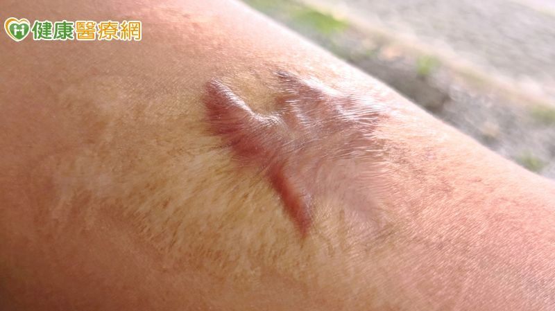 每天睡不到兩小時！中年女罹「蟹足腫」困擾30年　跨科聯手救回她的睡眠's story cover image