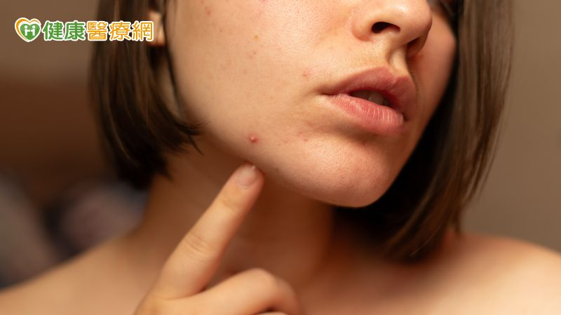 不只青春期！醫：痘痘也困擾上班族、更年期婦女　研究揭僅3成就醫's story cover image