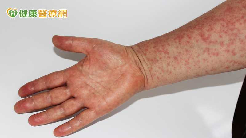 國際疫情持續！印尼返台男染麻疹　疾管署匡列384人監測至4／21's story cover image