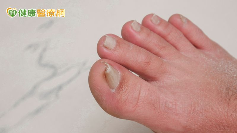 凍甲拔4次仍復發、「捲甲」痛到難穿鞋　甲床重建助甩寸步難行之苦's story cover image