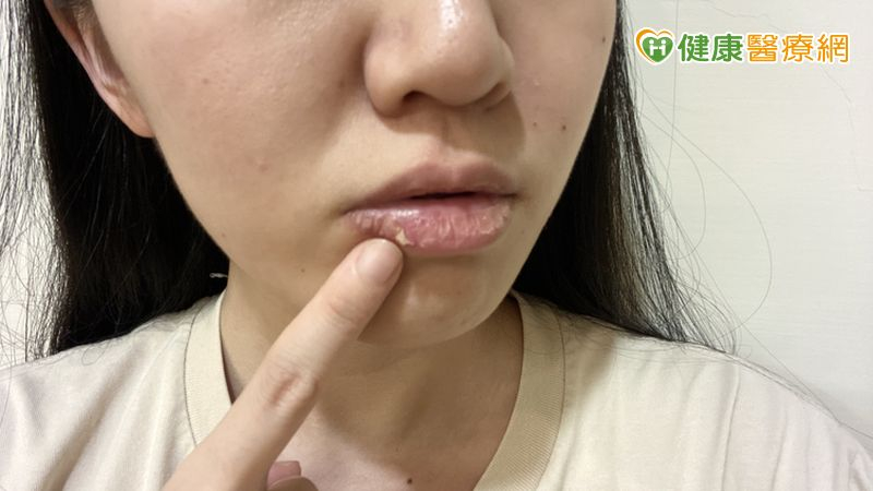 撕嘴皮撕到流血仍停不下來？醫揭可能與大腦1機制有關　當心是情緒警訊's story cover image