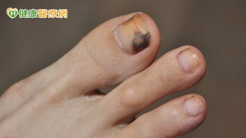 黑痣快速擴大恐是惡性黑色素瘤　醫揭免疫治療機轉與防護重點's story cover image