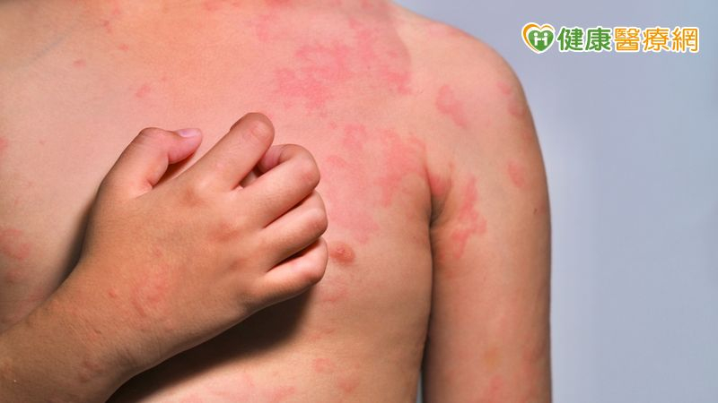 揪出過敏原,改善生活品質's OG Image